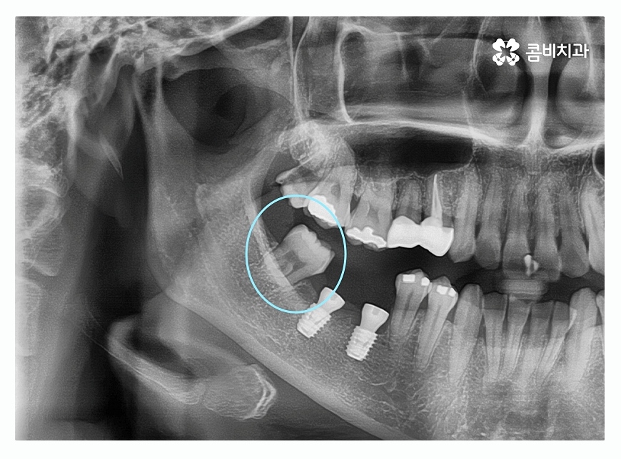 임플란트종류 잘알아보고 적용하려면 관련 이미지 4