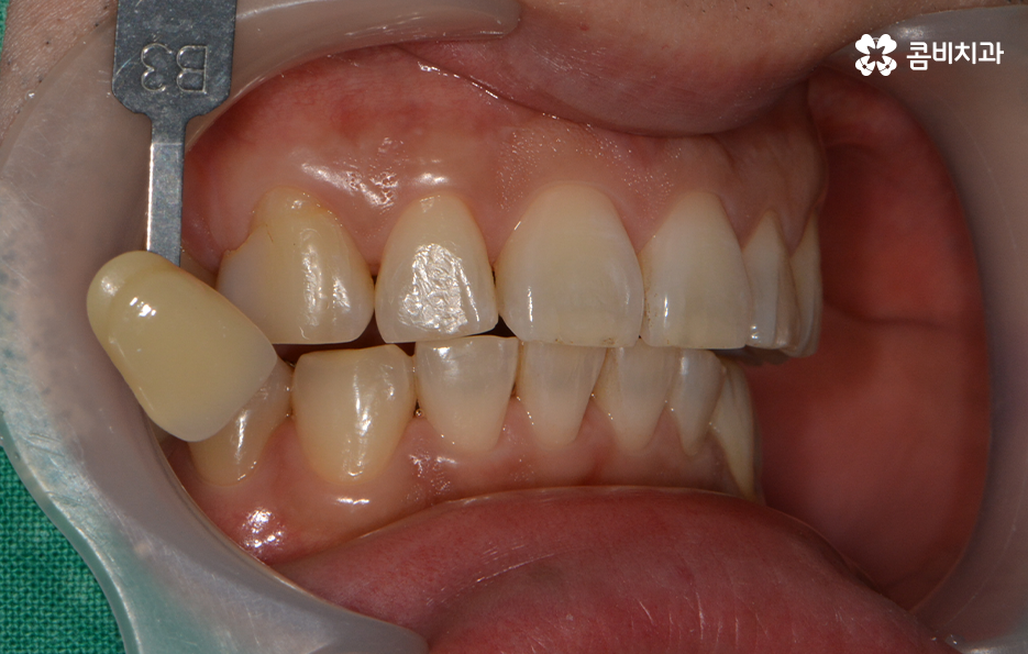 치과미백치료 누런 이가 고민되신다면 관련 이미지 3
