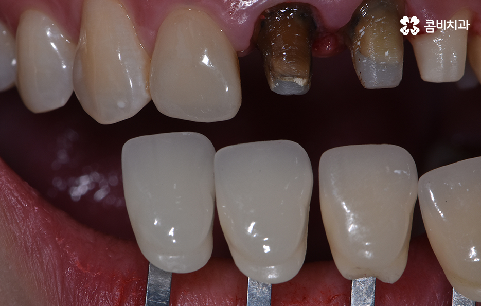 치아 깨짐 다시 튼튼하게 수복하기 위한 방법 관련 이미지 8
