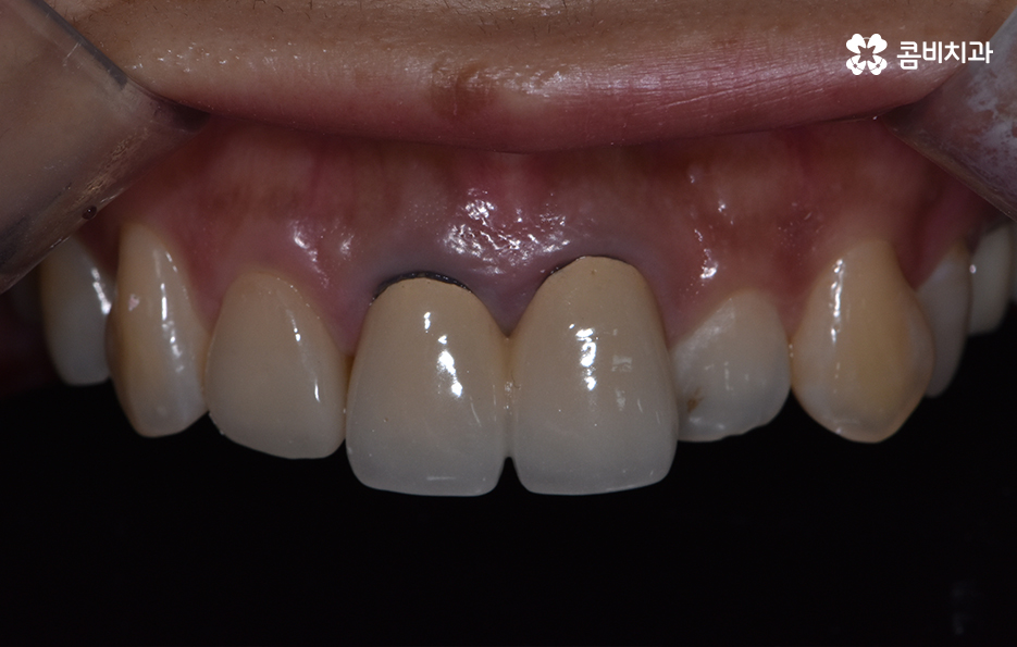 치아 깨짐 다시 튼튼하게 수복하기 위한 방법 관련 이미지 5