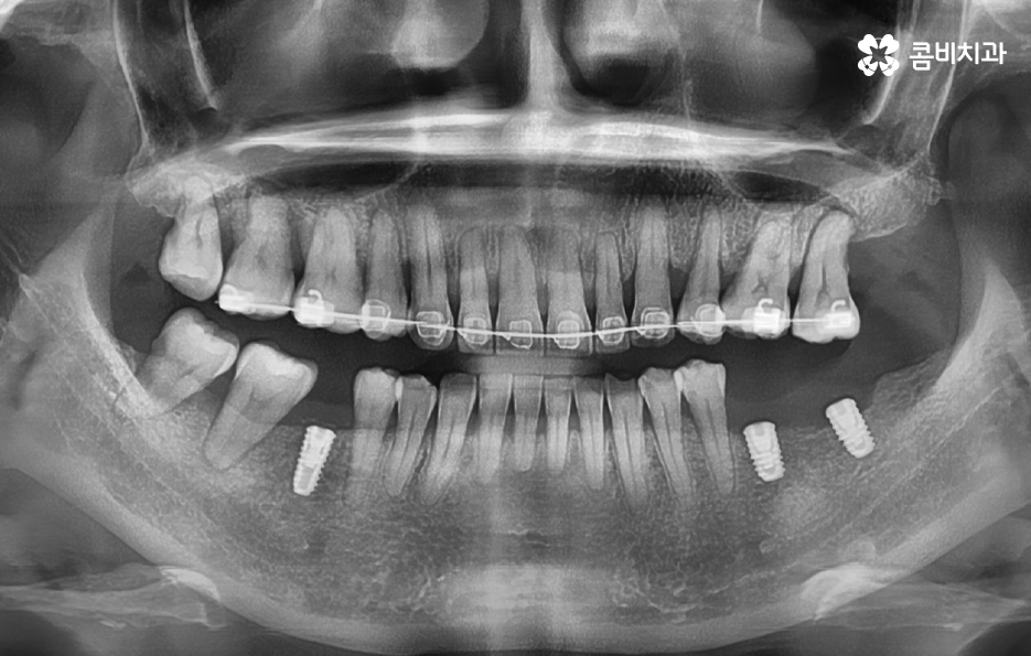 임플란트 해야 하는데 치아교정이 하고 싶다면 관련 이미지 8