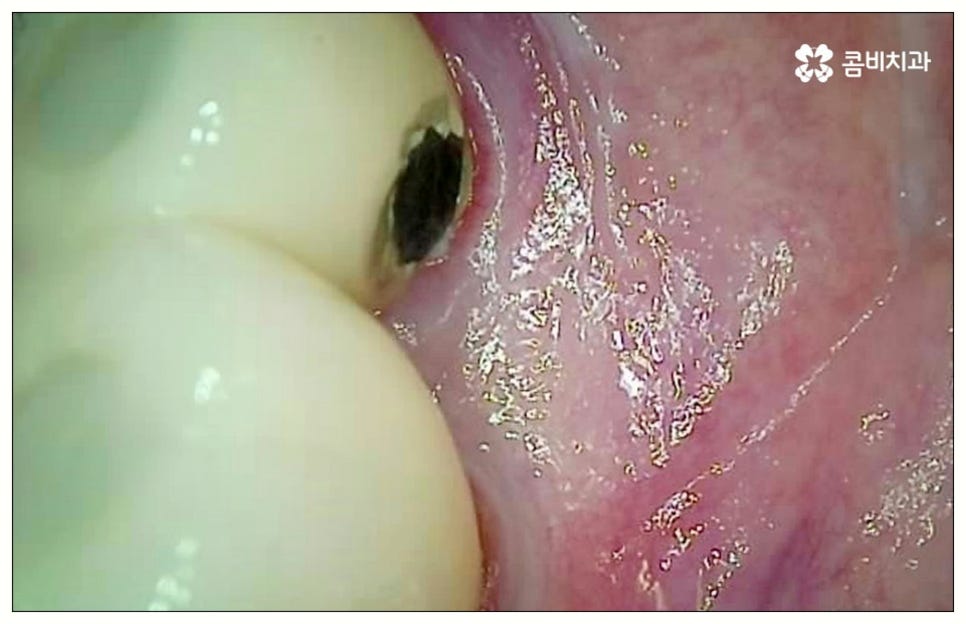 원데이임플란트 어떤가요? 관련 이미지 7