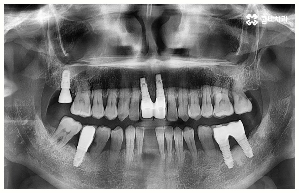 원데이임플란트 어떤가요? 관련 이미지 5