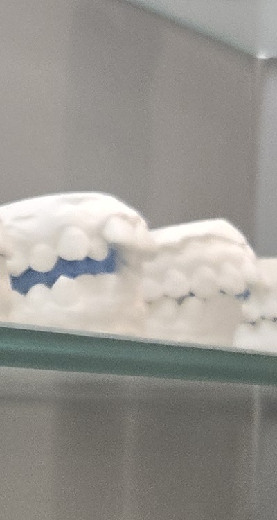 앞니 틀어짐 부분교정 얼마나 걸릴까 관련 이미지 28