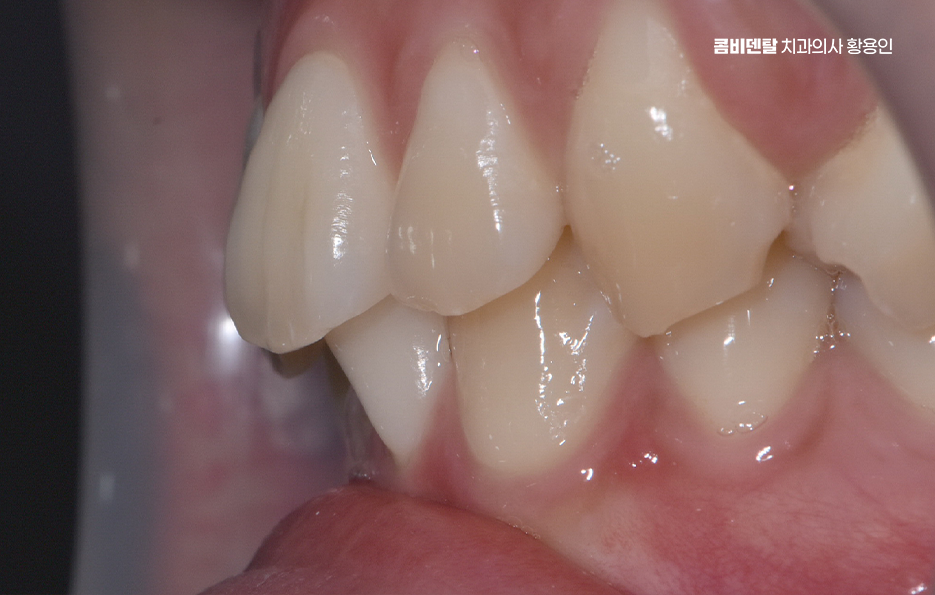 Can Crooked Lower Teeth Be Improved Without Extraction? image 5