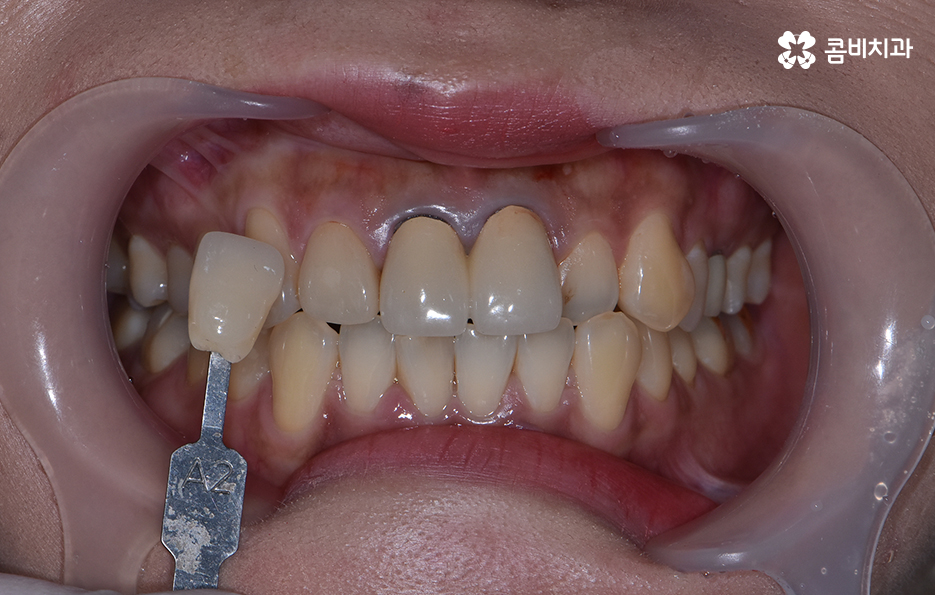 치아 깨짐 다시 튼튼하게 수복하기 위한 방법 관련 이미지 6