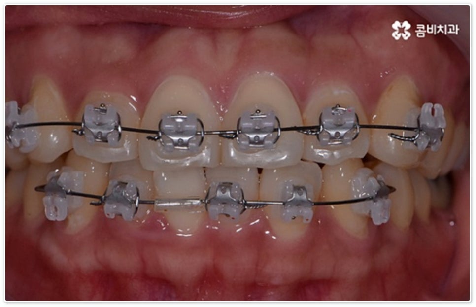 앞니부분교정 누구나 할수있나요? 관련 이미지 6