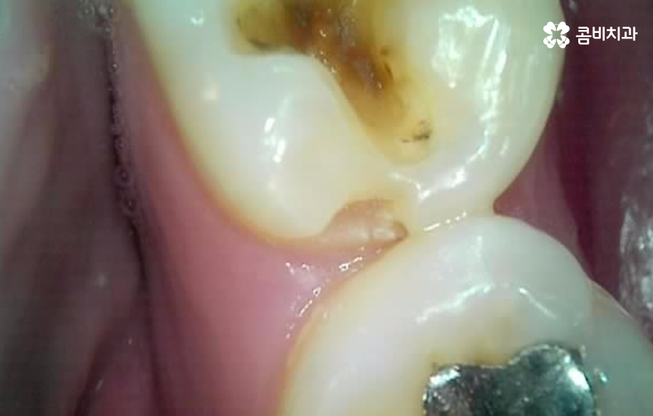 어금니 충치 깨짐 판단기준부터 세워보세요 관련 이미지 9