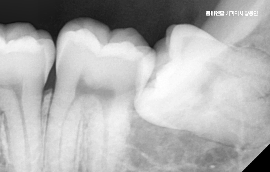 완전매복사랑니 발치 대학병원 꼭 가야하나요 관련 이미지 2