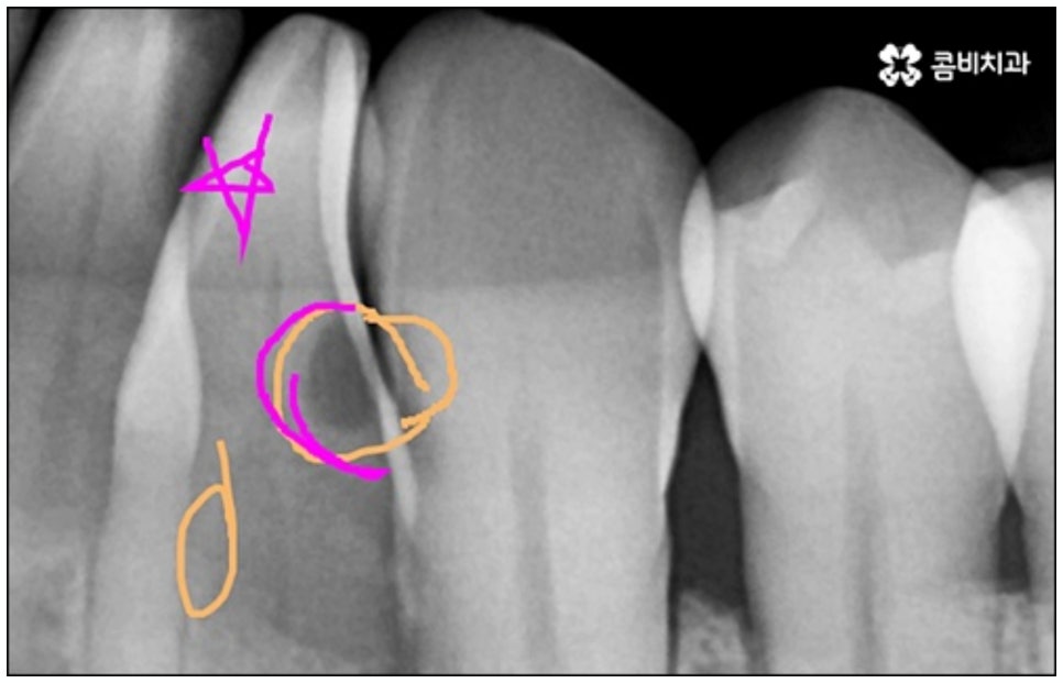 당일임플란트 나도 할수있나요 관련 이미지 13