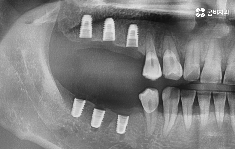 40대임플란트 치과에 이건 알고 가세요 관련 이미지 5