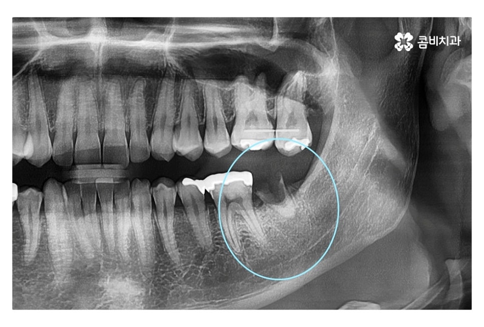 신경치료 후 크라운 시기를 놓치지 않으려면 관련 이미지 7