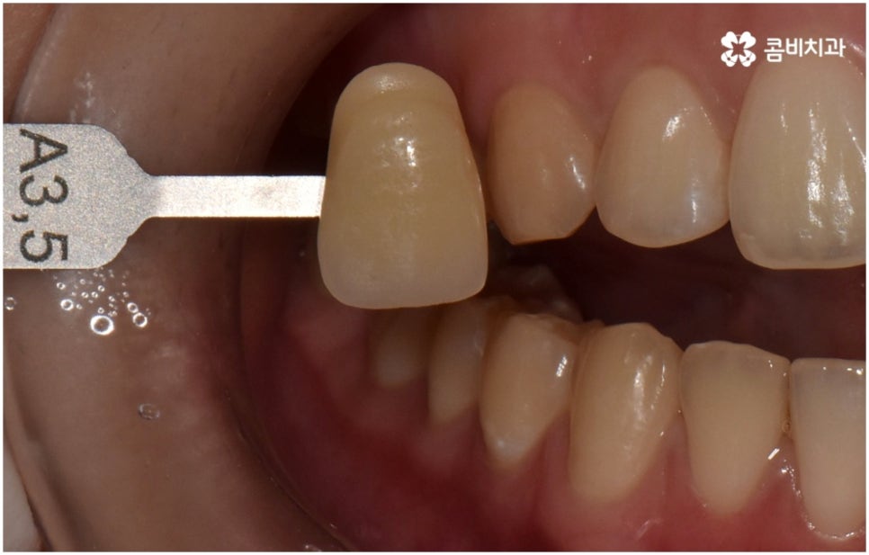 누런치아 하얗게 바꾸고 싶다면 관련 이미지 4