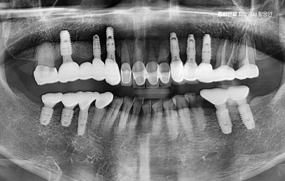 어금니 임플란트 안하면 후회하게 되는걸까 관련 이미지 11