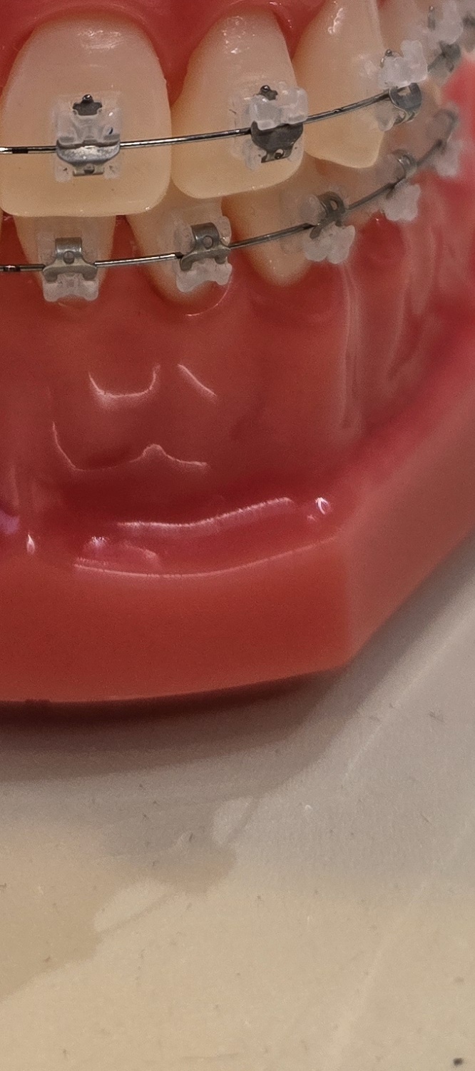 송곳니 덧니 발치 이럴때 해당되네요 관련 이미지 33