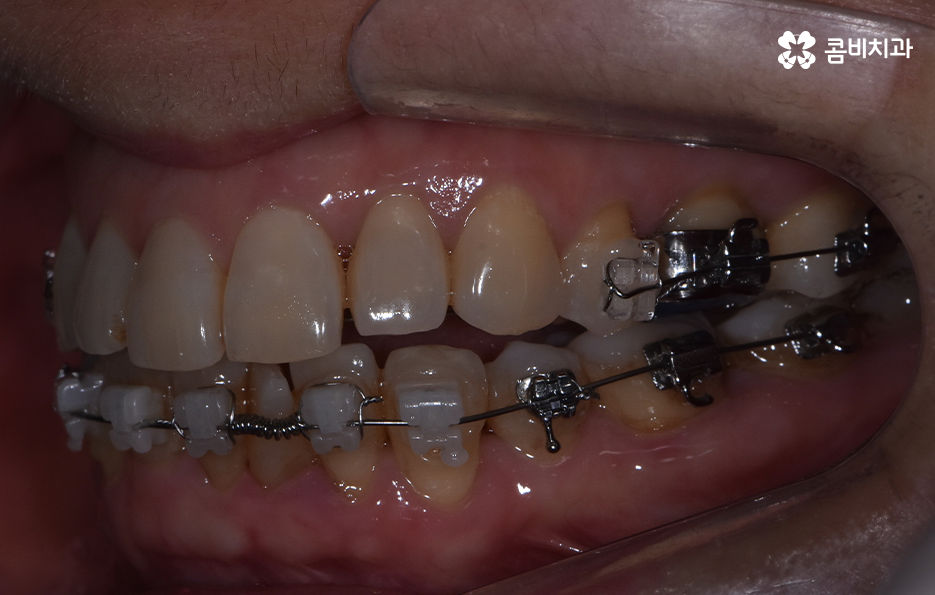 돌출입 콤비교정으로 얼굴까지 개선하는 방법은 관련 이미지 9