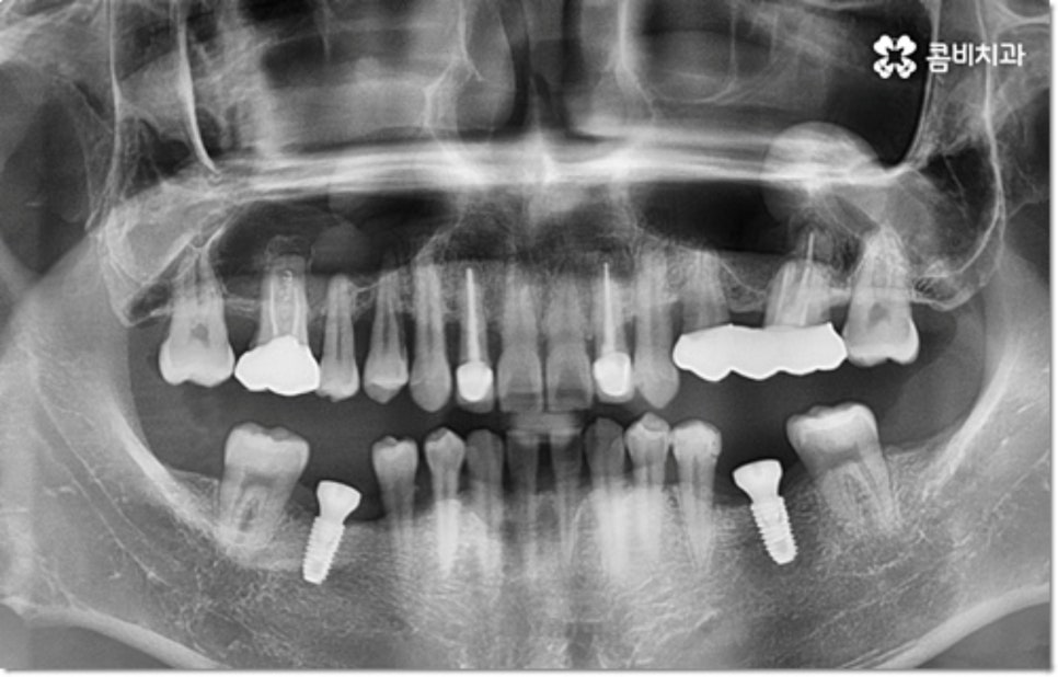 아랫니임플란트 주의할것들은? 관련 이미지 6