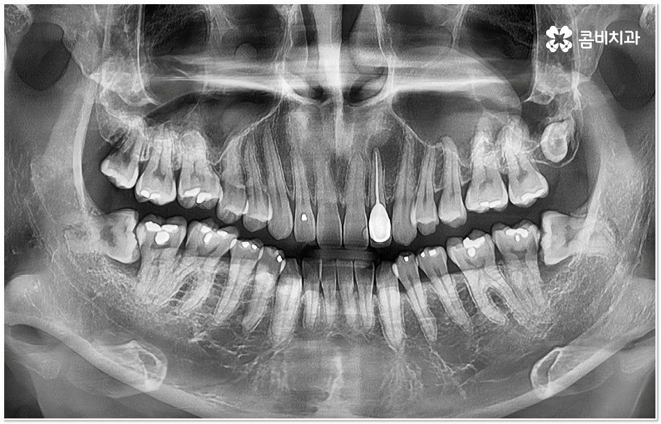 치아 사이 충치 어떻게 하나요 관련 이미지 3