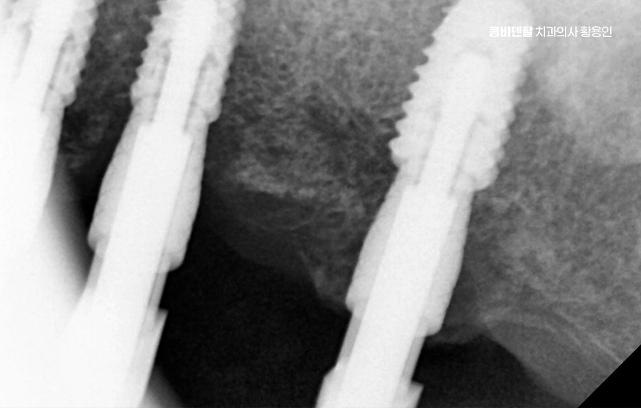 50대임플란트 꼼꼼하게 따져봐야할 포인트는 관련 이미지 8