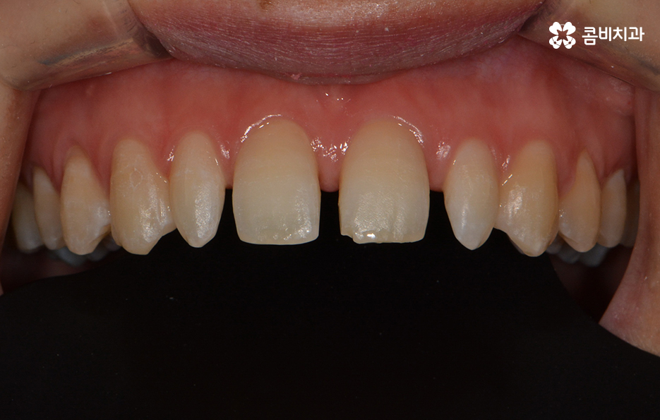 앞니 깨짐 치료와 교정이 병행되었던 사례 관련 이미지 9