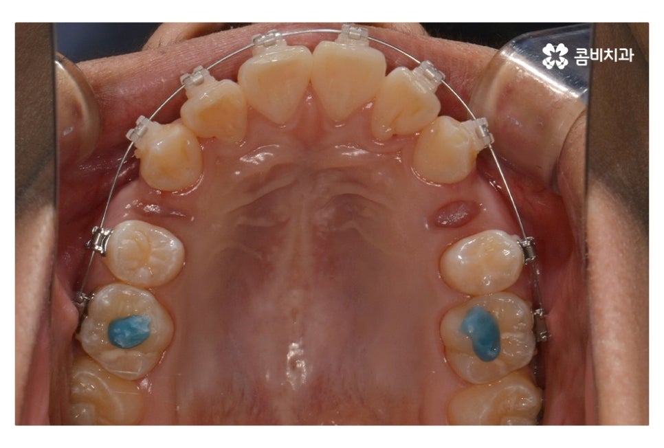 중학생치아교정 세심하게 체크하려면 관련 이미지 7