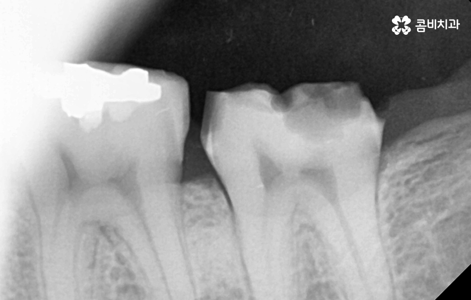 어금니 충치 발치 결국 뽑아야 할때와 살릴 수 있는 케이스 관련 이미지 11