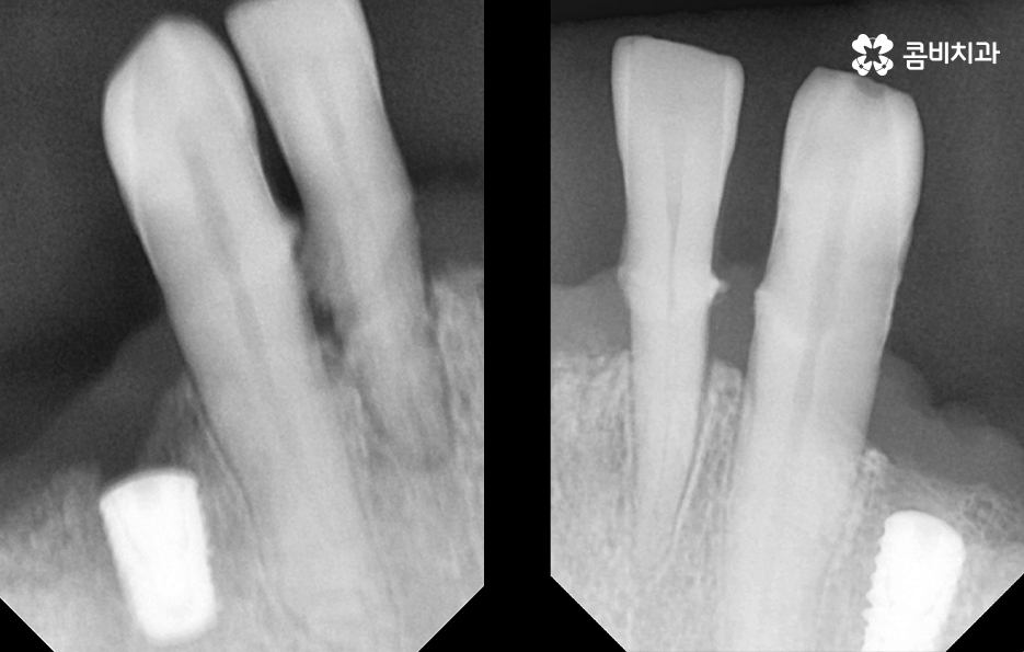 전체임플란트 어떤 방식으로 해야하나요 관련 이미지 3