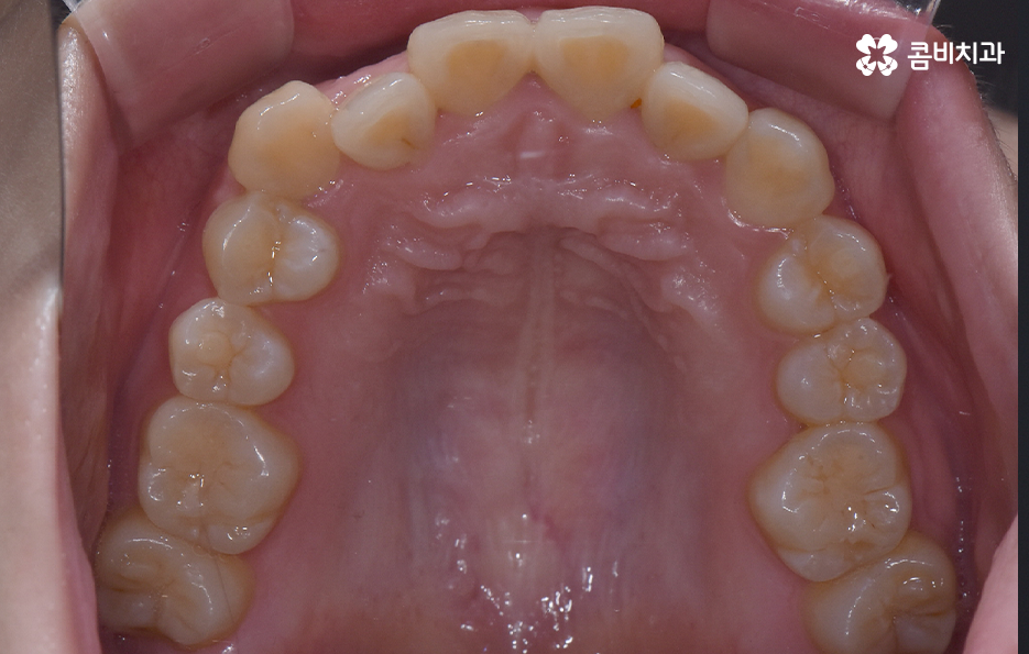 덧니 비발치 교정 자연스럽게 가능한 경우도 있어요 관련 이미지 5