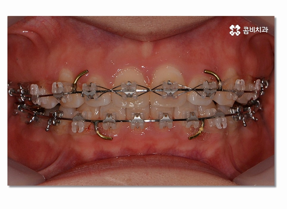 돌출입치아교정 부담이 크게 느껴진다면 관련 이미지 7