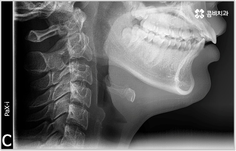 돌출입치아교정 언제가 적기인가요? 관련 이미지 1