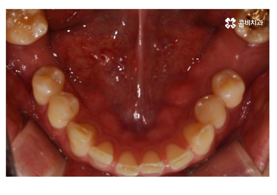 20대임플란트 잦아지는 이유를 알아본다면 관련 이미지 8