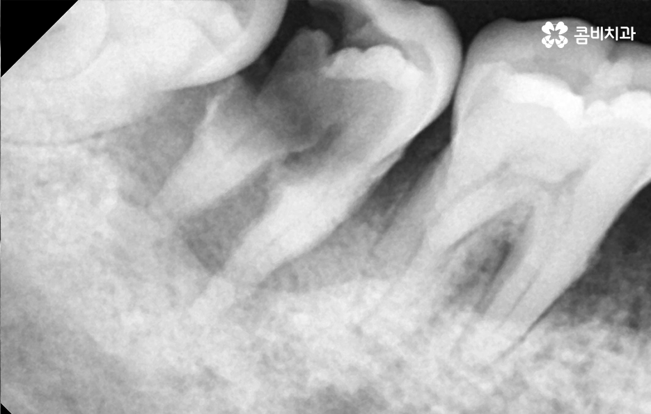 건강보험 임플란트 적용 받기 전에 알아두세요 관련 이미지 3