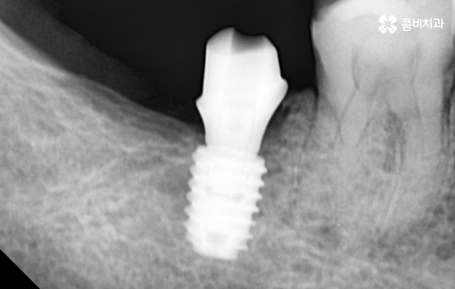 어금니 임플란트 기간 얼마나 예상해야 하나요 관련 이미지 6