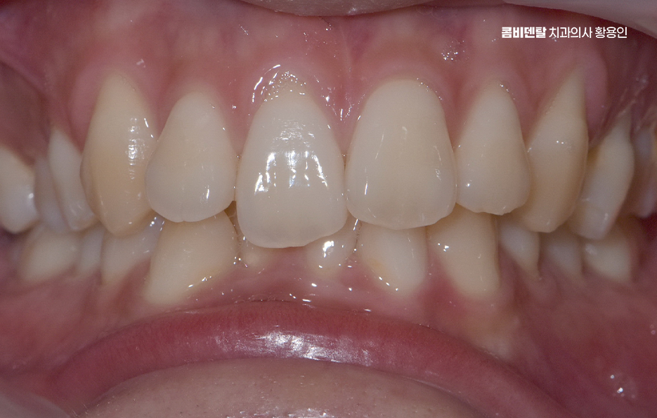 Can Crooked Lower Teeth Be Improved Without Extraction? image 2
