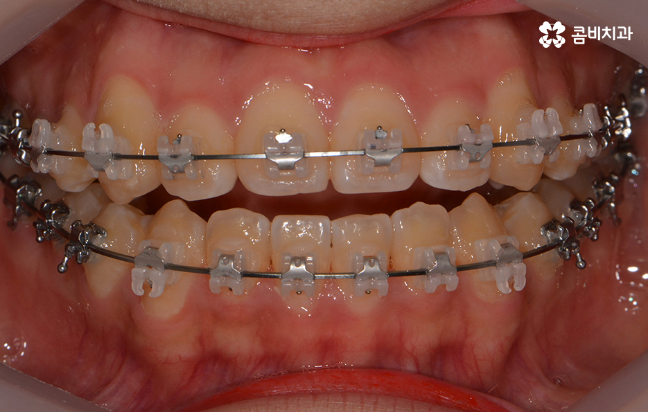 송곳니 덧니 뽑지 않고 해결된 사례 관련 이미지 9