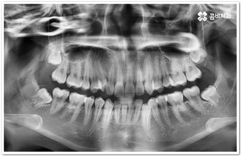 덧니 발치 언제 하나요? 관련 이미지 2