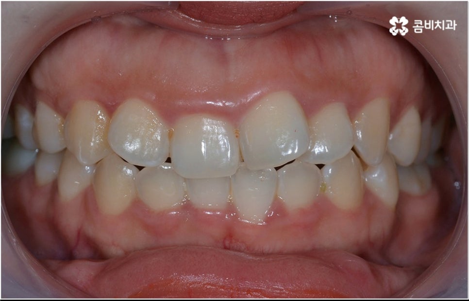 성인 치아교정 기간 걱정이 앞서나요 관련 이미지 3