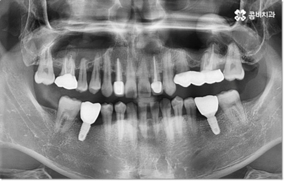 아랫니임플란트 주의할것들은? 관련 이미지 8