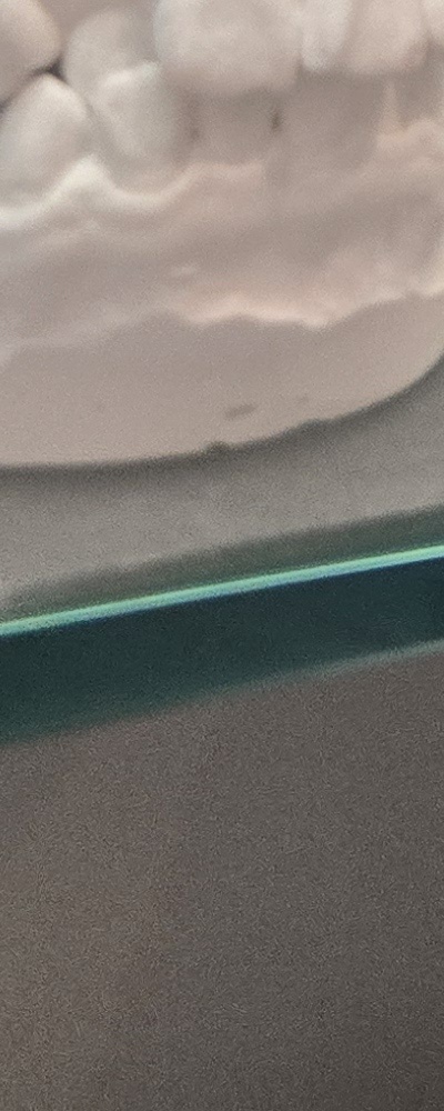 어르신 임플란트 지원 현명하게 활용하려면 관련 이미지 34