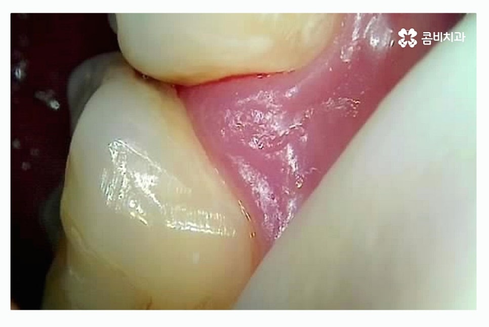 충치 레진 인레이 합리적으로 결정하려면 관련 이미지 10