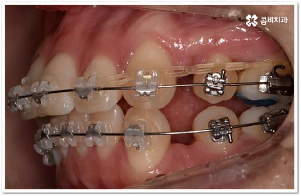 덧니 발치 언제 하나요? 관련 이미지 7