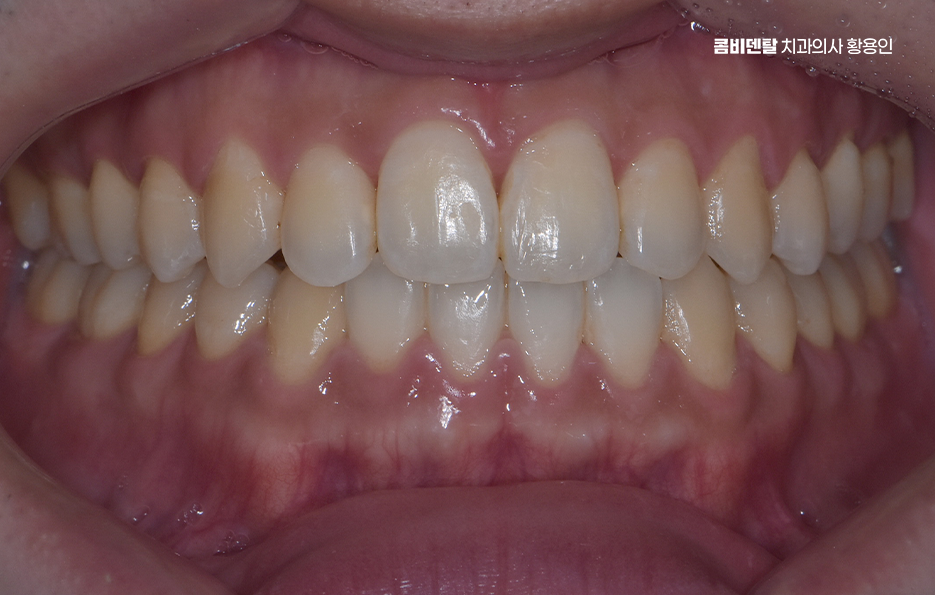 클리피씨교정 장단점 어떻게 비교하면 될까요 관련 이미지 6