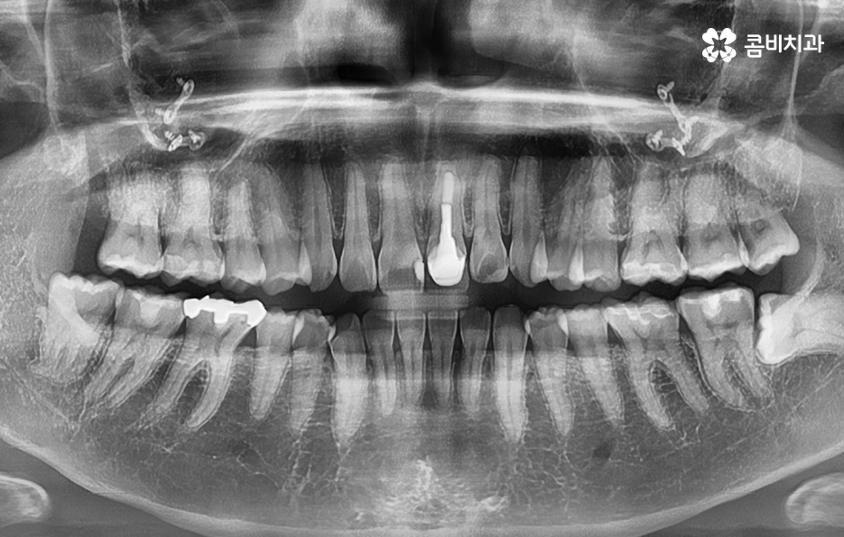 사랑니 발치 시기 이럴때 시작하면 좋아요 관련 이미지 6
