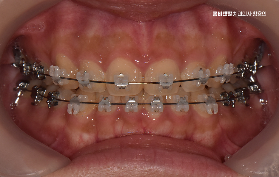 과개교합 교정 후 얼굴형 얼마나 바뀌나요 관련 이미지 6