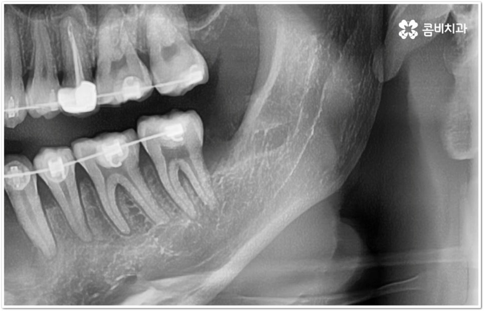 아래사랑니발치 망설이고 있다면 관련 이미지 12