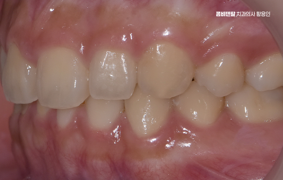 과개교합 교정 후 얼굴형 얼마나 바뀌나요 관련 이미지 4