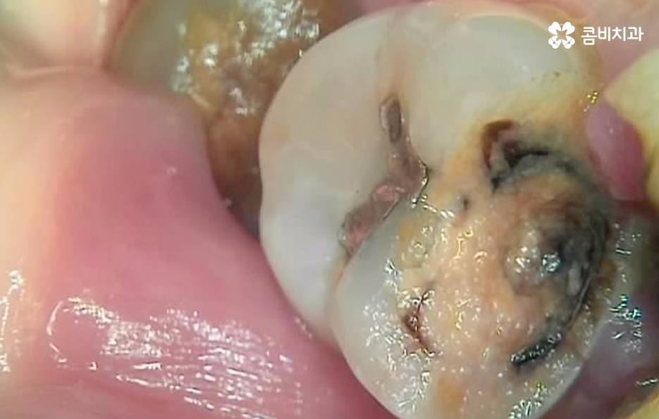 누워있는 사랑니 꼭 뽑아야 하는 경우는 언제일까 관련 이미지 7