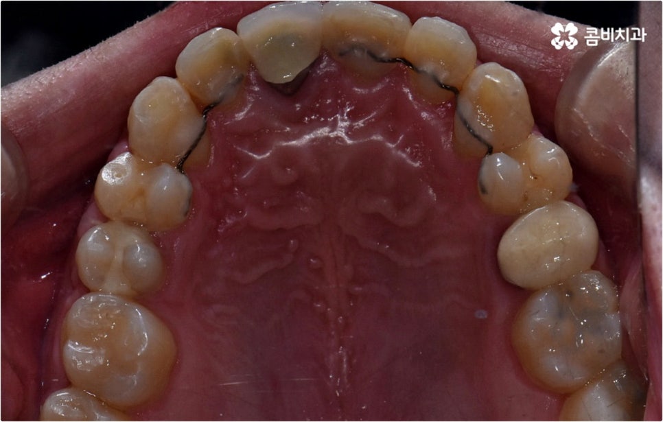 덧니교정 하고싶다면 관련 이미지 10