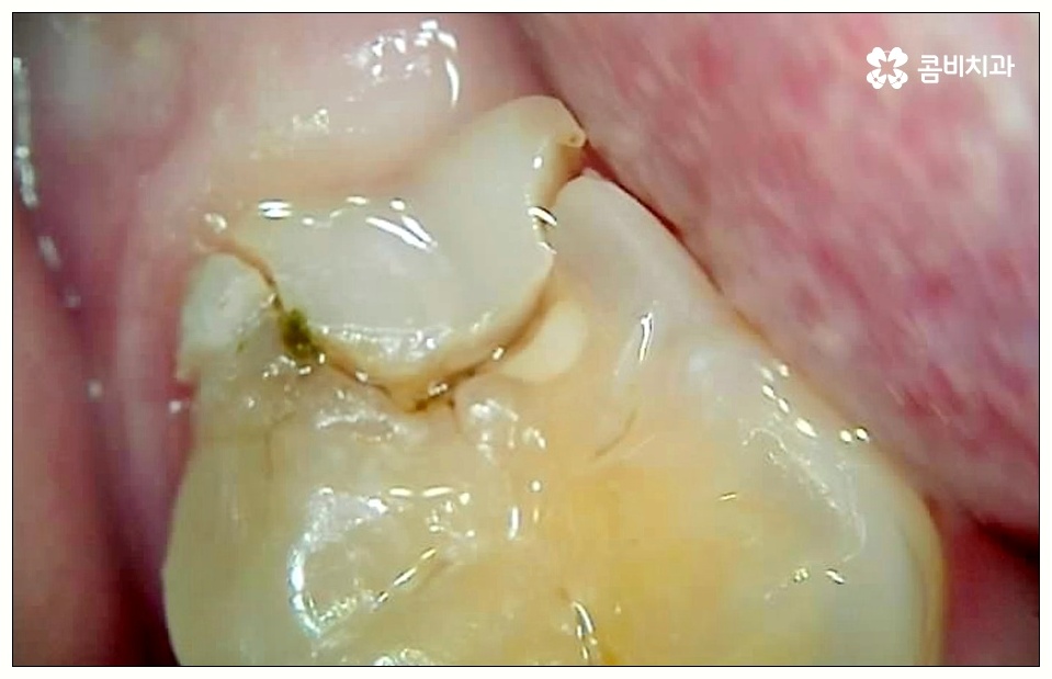 어금니 사이 충치 빠르게 대응해야 관련 이미지 5