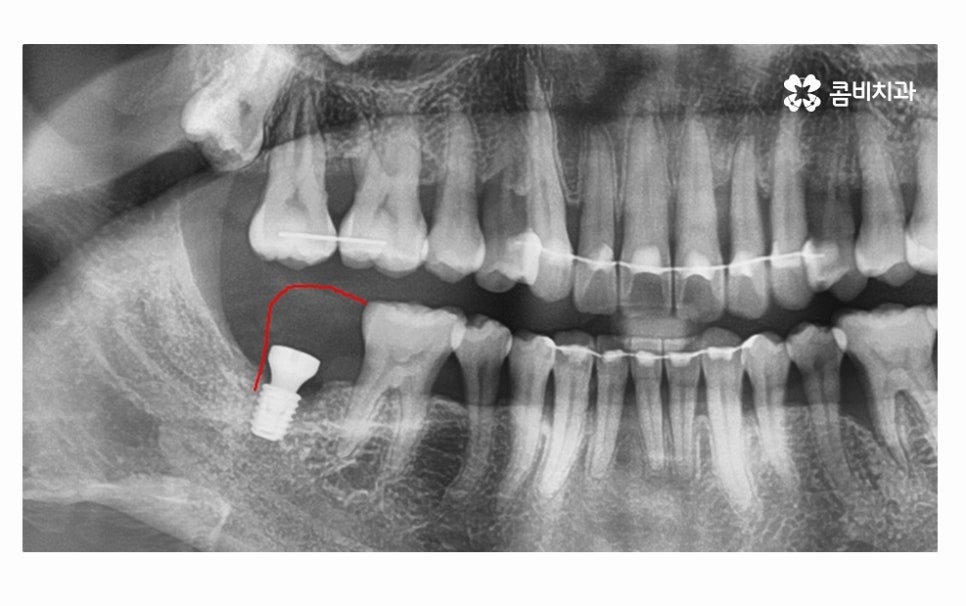 어금니 발치 심각해지기 전에 막으려면 관련 이미지 11